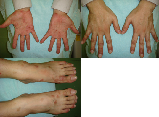 掌蹠膿疱症（しょうせきのうほうしょう）症例