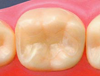 白い歯によるむし歯治療