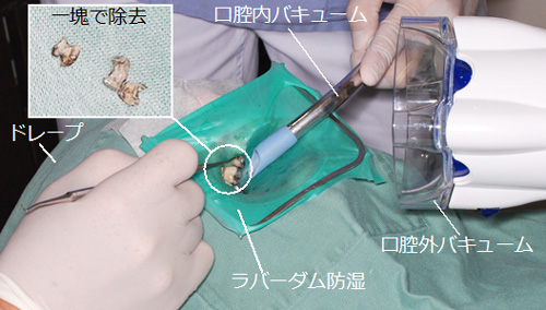 修復治療・交換治療
